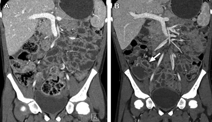 سی تی اسکن | سی تی انتروگرافی