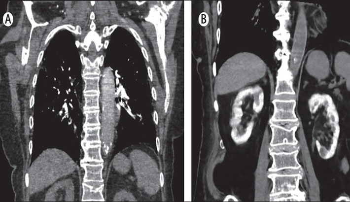 سی تی اسکن | بیماران با نارسایی کلیه