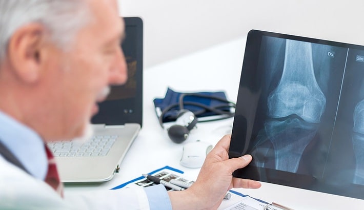 پوکی استخوان | مصرف مکمل کلسیم پوکی استخوان | مصرف مکمل کلسیم