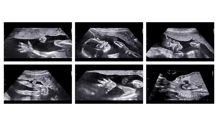 سونوگرافی | تعداد مجاز سونوگرافی سونوگرافی | تعداد مجاز سونوگرافی