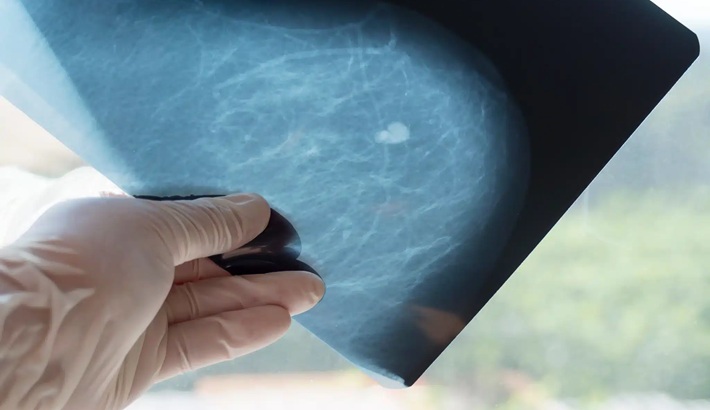 کیست سینه | مراجعه به پزشک