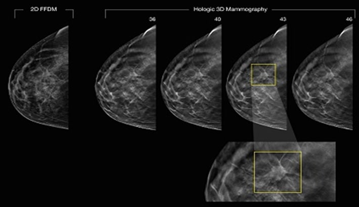 کیست سینه | کیست سینه ساده در مقابل کیست سینه پیچیده