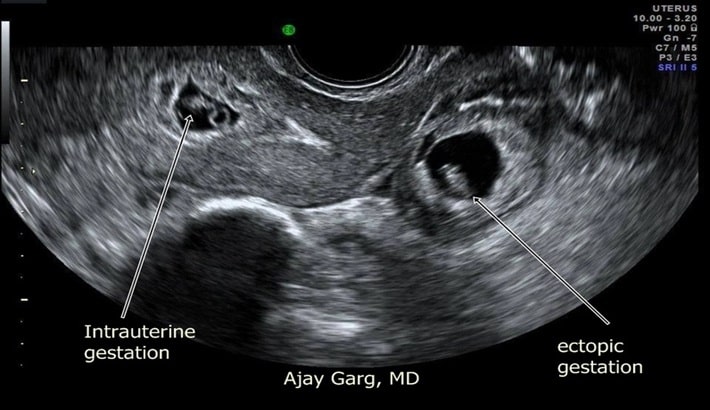 سونوگرافی | بارداری خارج رحمی سونوگرافی | بارداری خارج رحمی