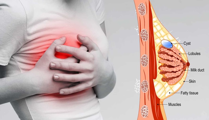 کیست سینه | بازگشت کیست سینه