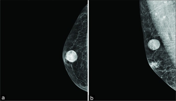 کیست سینه | ارتباط بین کیست سینه و کیست تخمدان