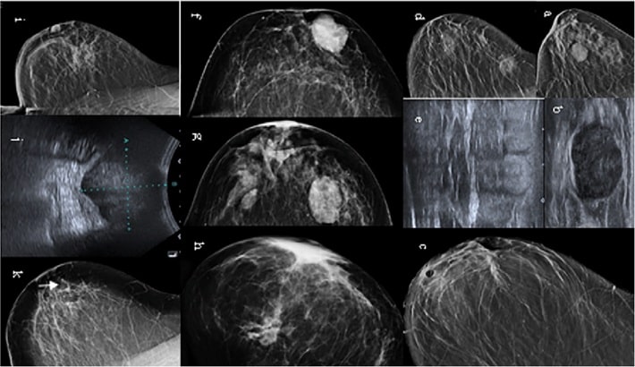 کیست سینه | از بین رفتن خود به خود کیست‌های سینه