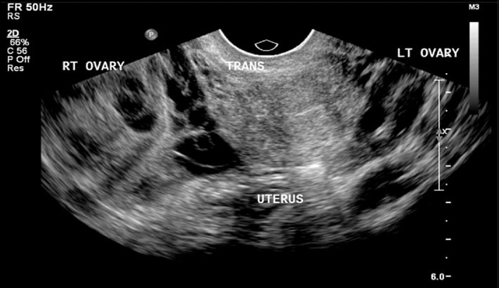 سونوگرافی در شیراز | سونوگرافی لگن در زنان