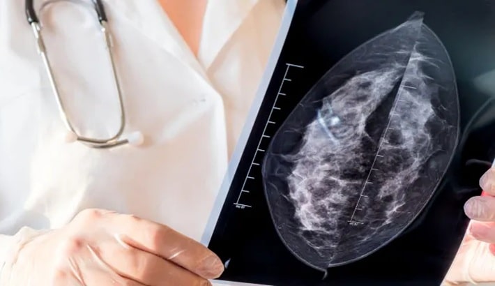 کیست سینه | تأثیر استرس و سبک زندگی