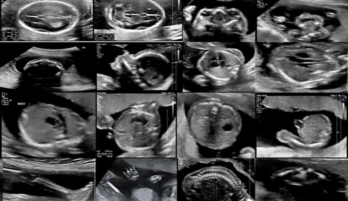 سونوگرافی | سونوگرافی آنومالی سونوگرافی | سونوگرافی آنومالی
