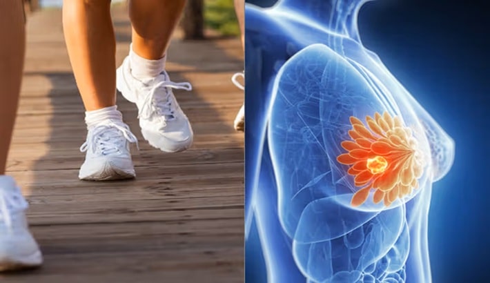 کیست سینه | تاثیر ورزش