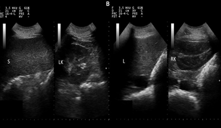 سونوگرافی | سونوگرافی کبد و طحال سونوگرافی | سونوگرافی کبد و طحال