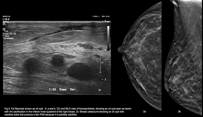 کیست سینه | تشخیص کیست با ماموگرافی یا سونوگرافی