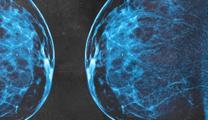 کیست سینه | کیست‌های بزرگ