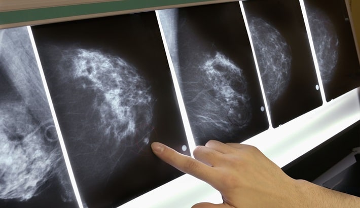 کیست سینه | نقش نوسانات طبیعی هورمونی