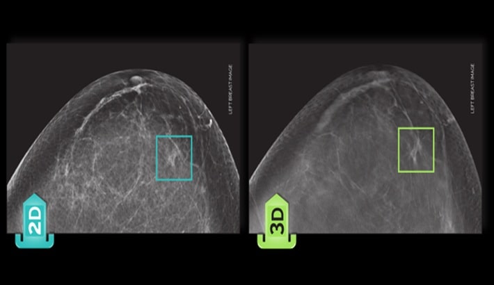 ماموگرافی شیراز | تفاوت ماموگرافی دوبعدی و سهبعدی ماموگرافی شیراز | تفاوت ماموگرافی دوبعدی و سهبعدی