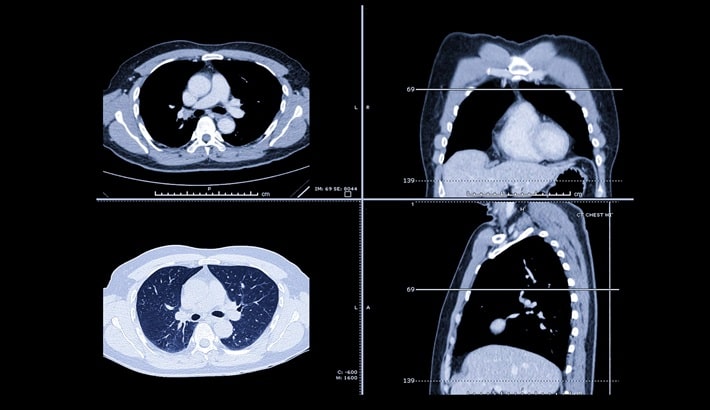 سی تی اسکن ریه | تفاوت در میزان تابش اشعه