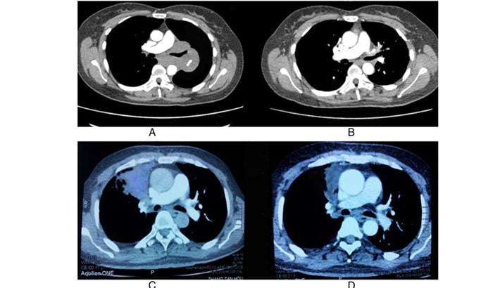 سی تی اسکن ریه | خطرات برای کودک