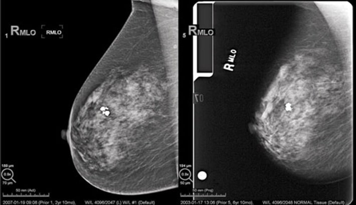 علائم سرطان سینه در زنان | تفاوت بین توده‌های خوش‌خیم و بدخیم