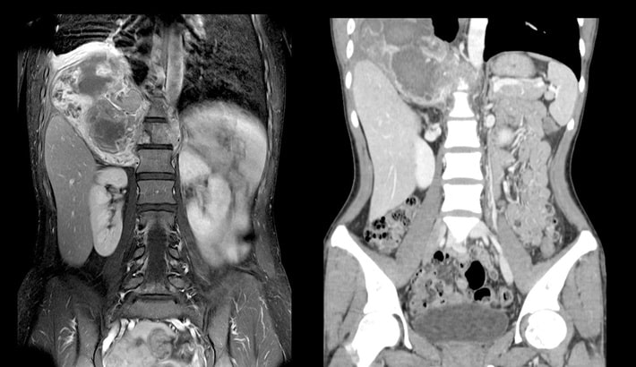 سی تی اسکن ریه | مقایسه سی تی اسکن ریه با MRI ریه