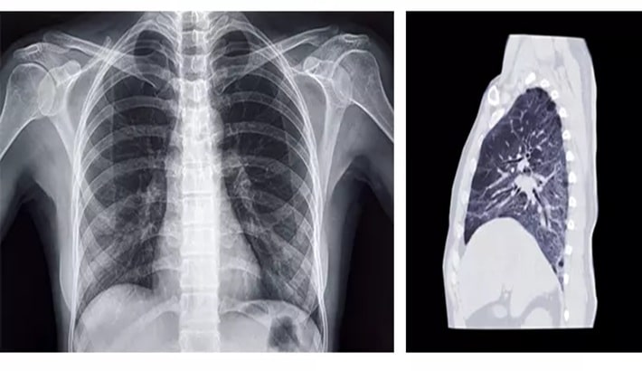 سی تی اسکن ریه | عوارض سی تی اسکن