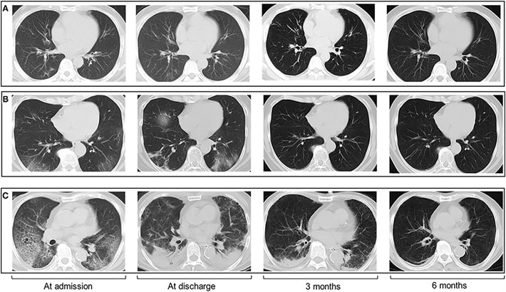 سی تی اسکن ریه | خواندن گزارش