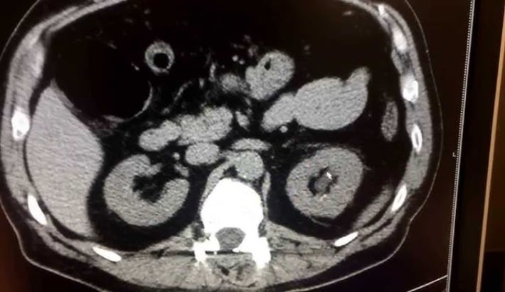 سی تی اسکن در شیراز | سی تی اسکن کلیه