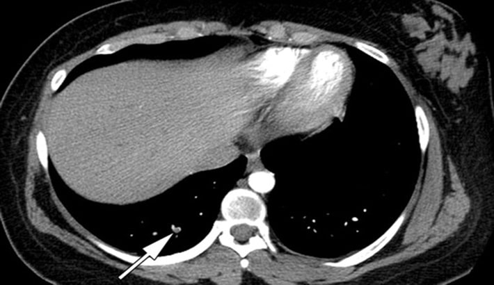 سی تی اسکن ریه | خطرات احتمالی