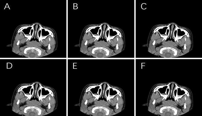 سی تی اسکن در شیراز | سی تی اسکن سینوس