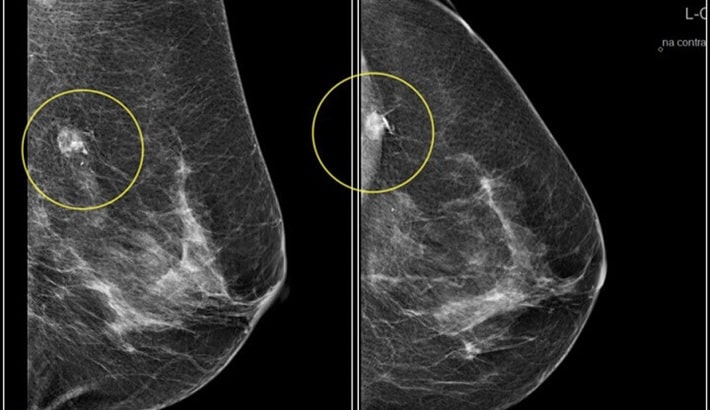 ماموگرافی شیراز | تشخیص زودهنگام سرطان سینه