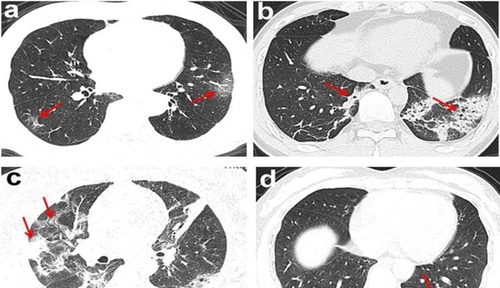 سی تی اسکن ریه | نقش ماده حاجب