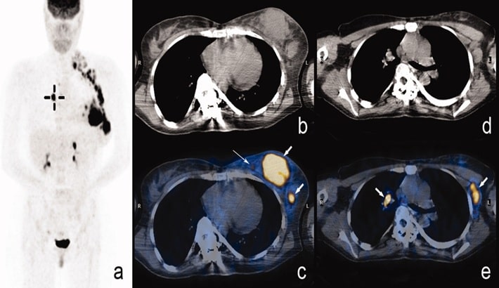 سی تی اسکن ریه | تاثیر بر بارداری و شیردهی