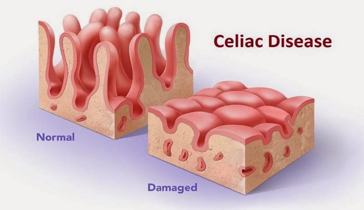 تراکم استخوان | بیماری سلیاک