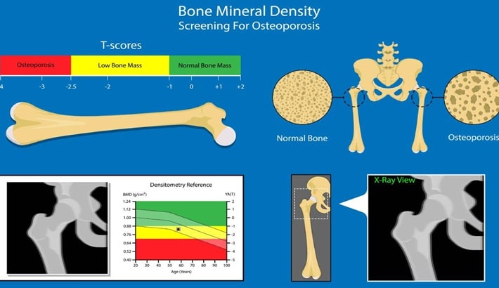 تراکم استخوان | بررسی تراکم استخوان در سنین مختلف  تراکم استخوان | بررسی تراکم استخوان در سنین مختلف