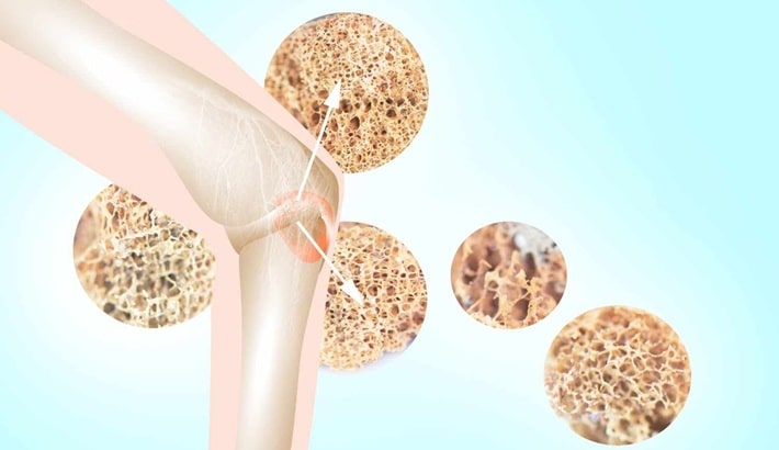 تراکم استخوان | سنجش تراکم استخوان در افراد دارای اضافه وزن