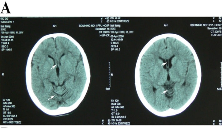 سی تی اسکن مغز | خواندن گزارش سی تی اسکن مغز | خواندن گزارش