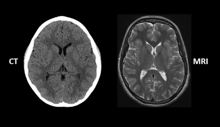 سی تی اسکن مغز | مقایسه با ام آر آی سی تی اسکن مغز | مقایسه با ام آر آی