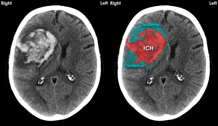 سی تی اسکن مغز | خونریزی مغزی سی تی اسکن مغز | خونریزی مغزی
