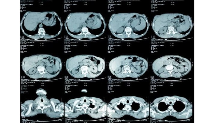 سی تی اسکن شکم | تشخیص تومورها و سرطان‌ها