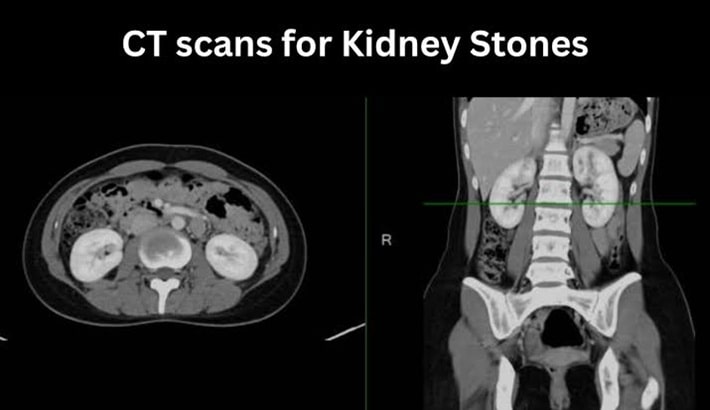 سی تی اسکن شکم | سنگ کلیه