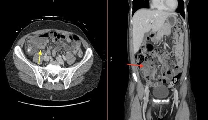 سی تی اسکن شکم | بررسی آپاندیسیت
