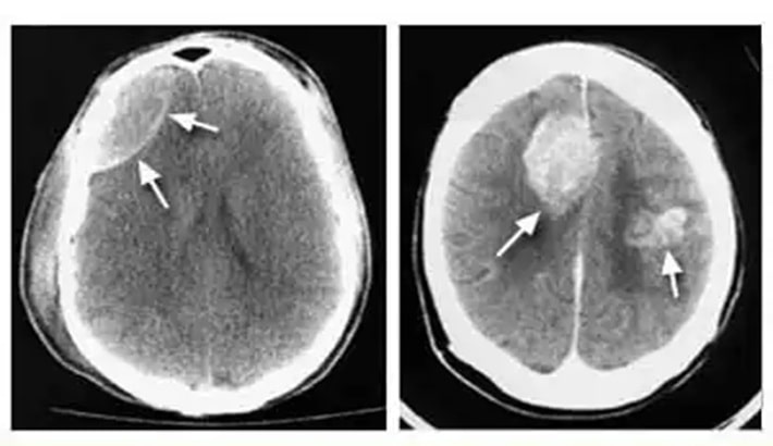 سی تی اسکن مغز | تومورهای مغزی سی تی اسکن مغز | تومورهای مغزی