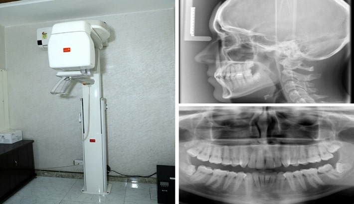 عکس opg شیراز | تشخیص عفونت دندان و آبسه عکس opg شیراز | تشخیص عفونت دندان و آبسه
