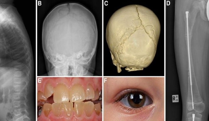 پوکی استخوان | پوکی استخوان در کودکان و نوجوانان