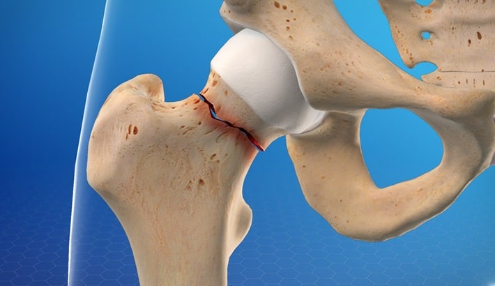 پوکی استخوان | ارتباط تغذیه نامناسب