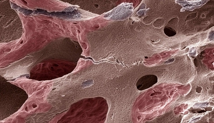 پوکی استخوان | تاثیر استرس و افسردگی