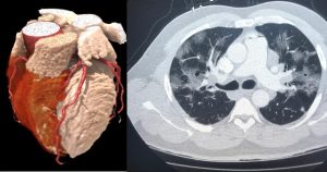 سی تی اسکن قلب