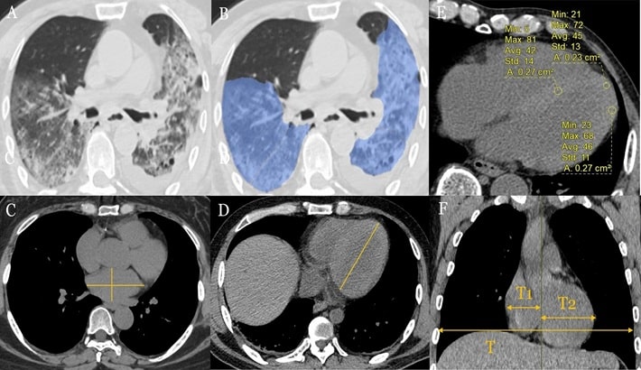 سی تی اسکن قلب | تفاوت سی تی اسکن قلب با تزریق و بدون تزریق
